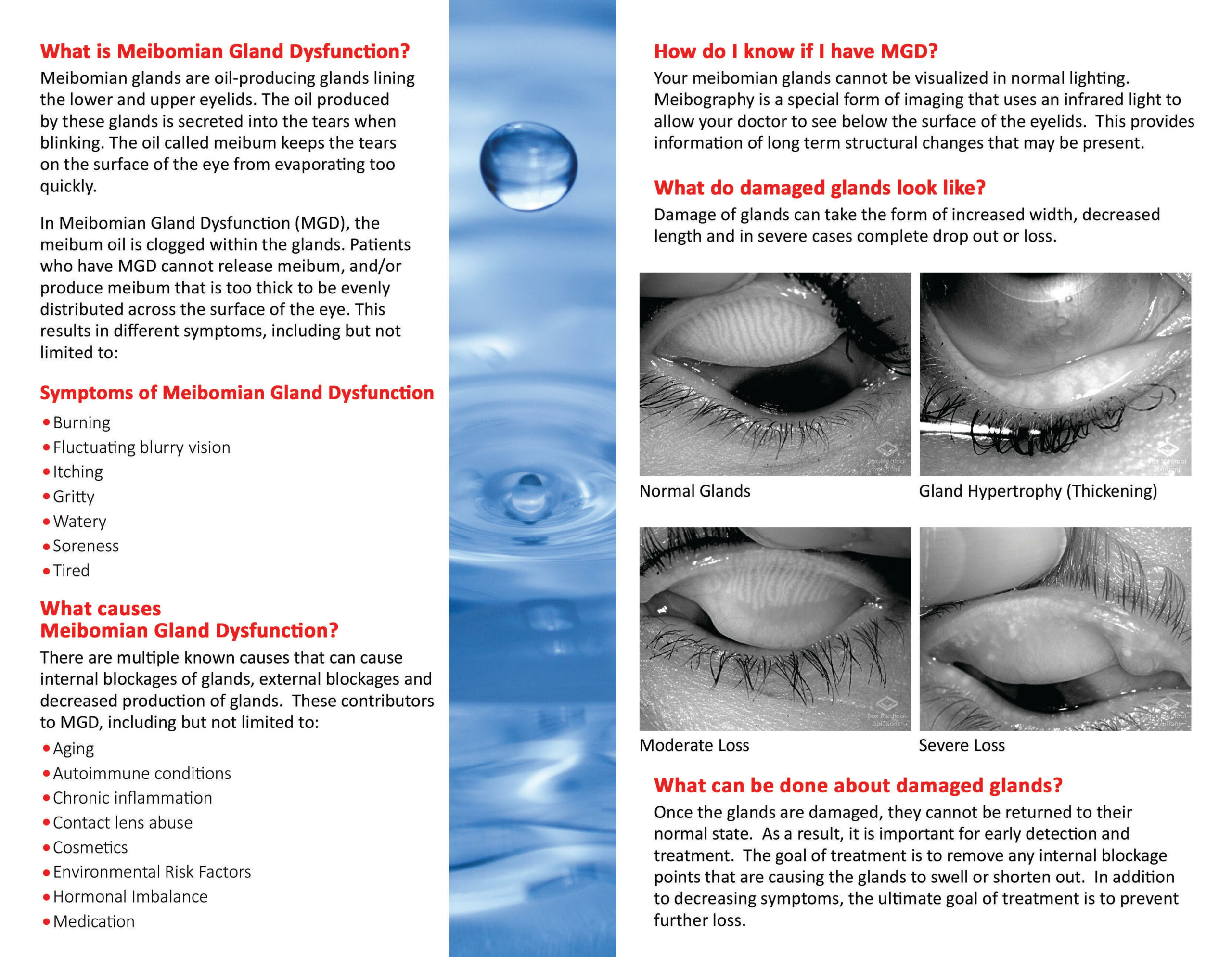 Dry Eyes Meibomian Gland Dysfunction Treatment Infoupdate Dry Eyes Meibomian Gland Dysfunction Treatment Infoupdate