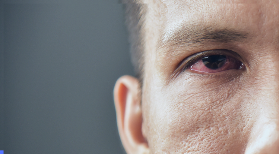 eye inflammation treatment