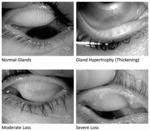 Meibography Overview l Innovative Eye Care